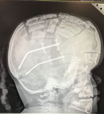 Ldr Fitzpatrick's daughter head scan